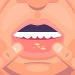 Top 10 Mouth Ulcer Gels in India