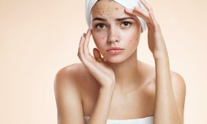 Ayurvedic Acne Cream Manufacturers in India 